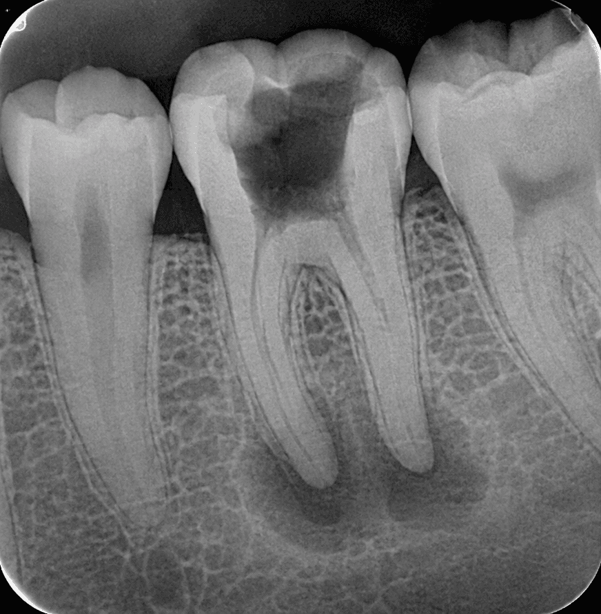 Antes — Endodoncia