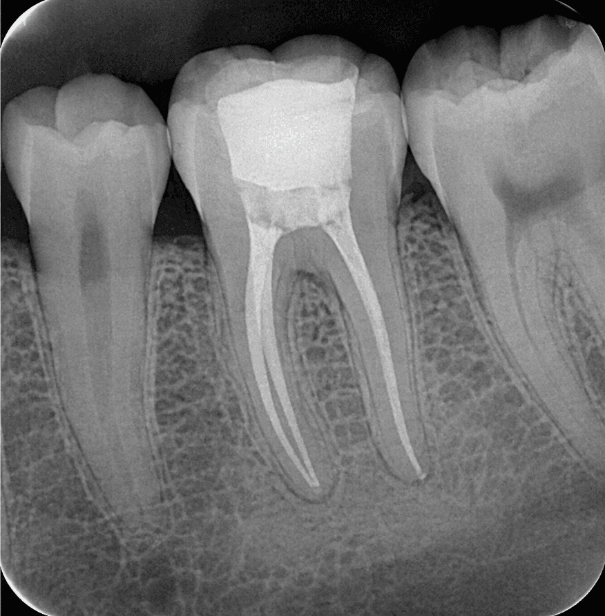 Después — Endodoncia