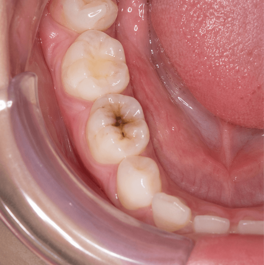 Antes — Odontopediatría
